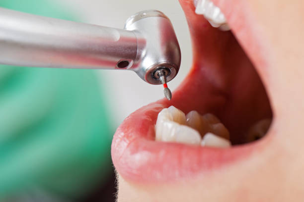 Best Emergency Tooth Extraction in Berne, IN